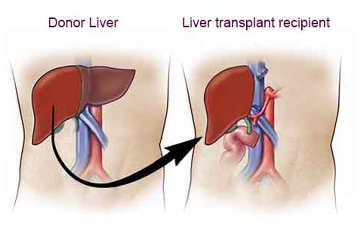 Liver Transplant Surgery