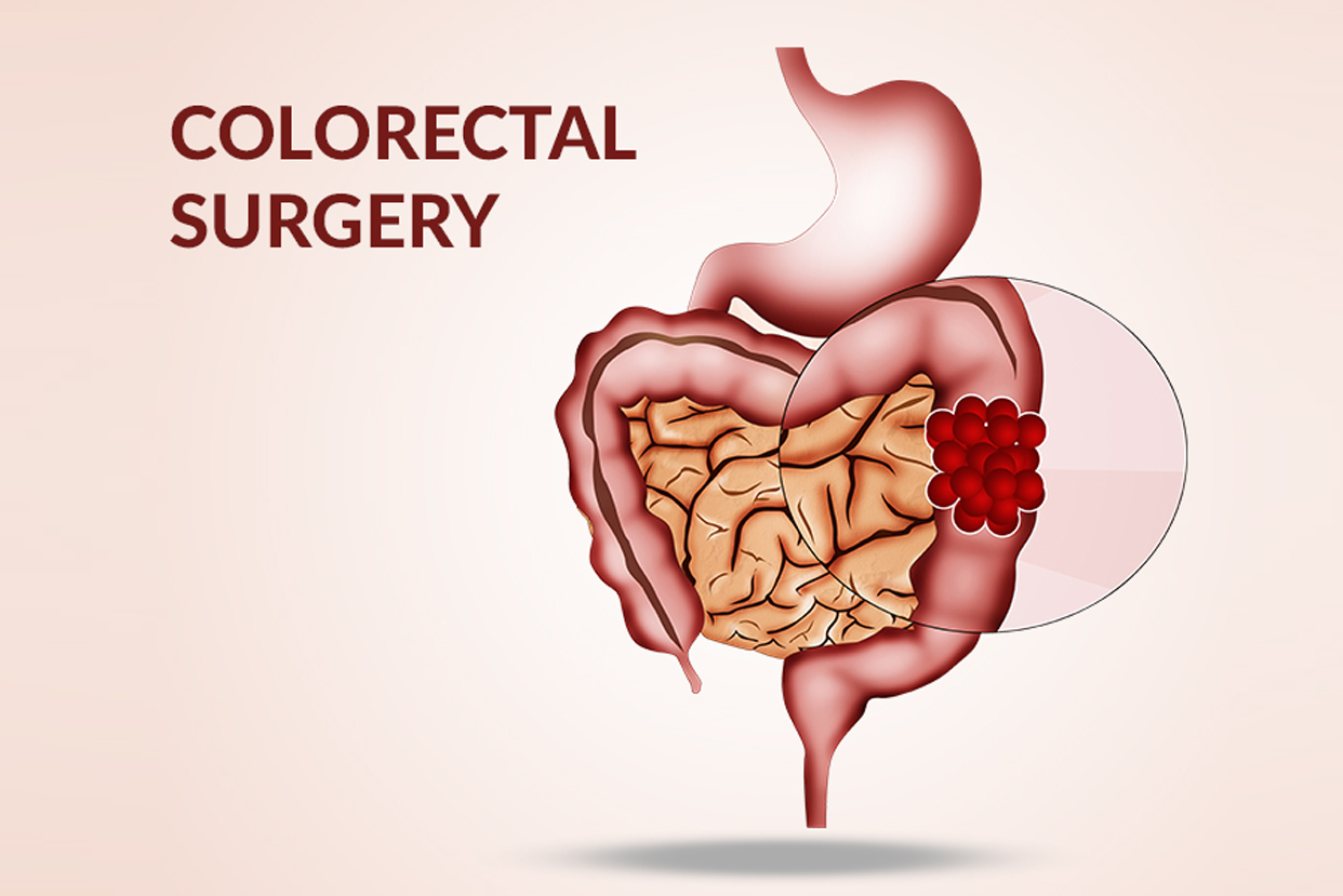 Colorectal Surgery